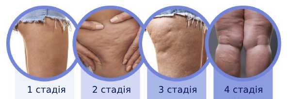 стадії цилюліту